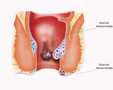 Fistula Treatment